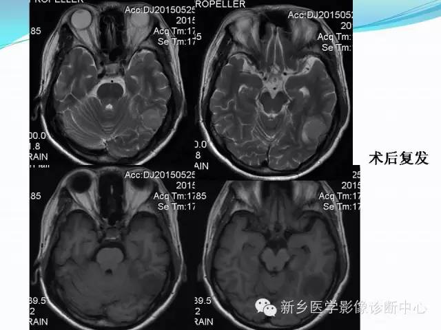 【病例】成人小脑髓母细胞瘤1例影像表现