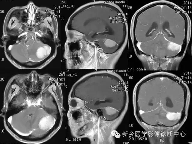 【病例】成人小脑髓母细胞瘤1例影像表现