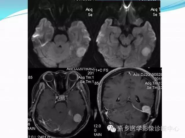 【病例】成人小脑髓母细胞瘤1例影像表现