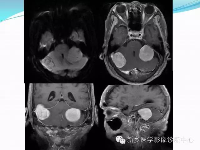 【病例】成人小脑髓母细胞瘤1例影像表现