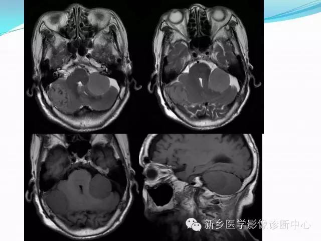 【病例】成人小脑髓母细胞瘤1例影像表现