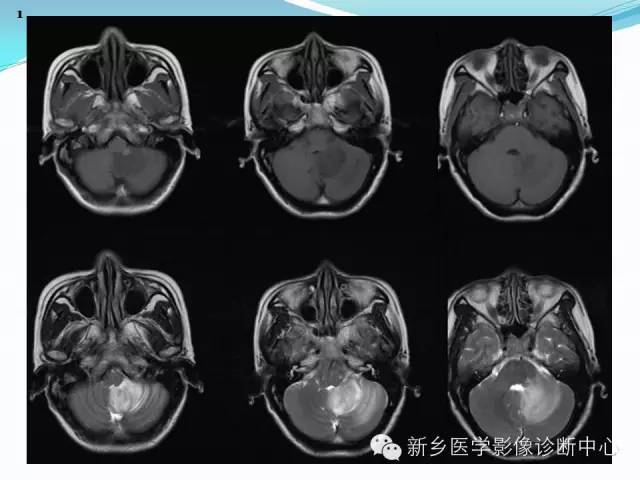 【病例】成人小脑髓母细胞瘤1例影像表现