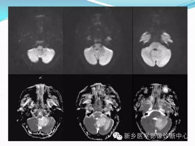 【病例】成人小脑髓母细胞瘤1例影像表现