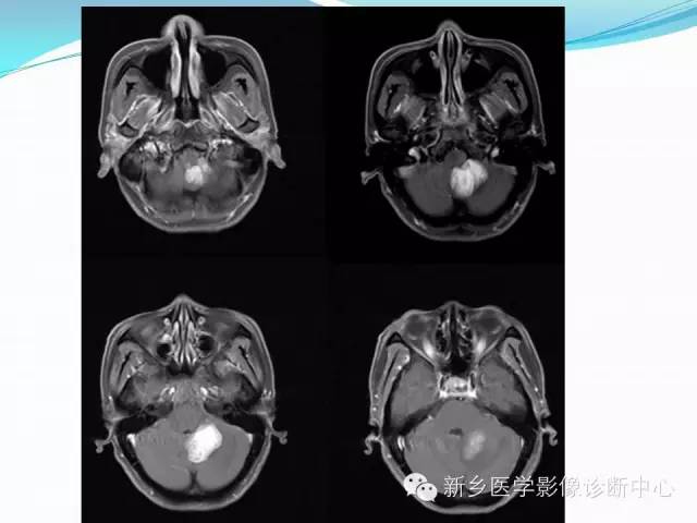 【病例】成人小脑髓母细胞瘤1例影像表现