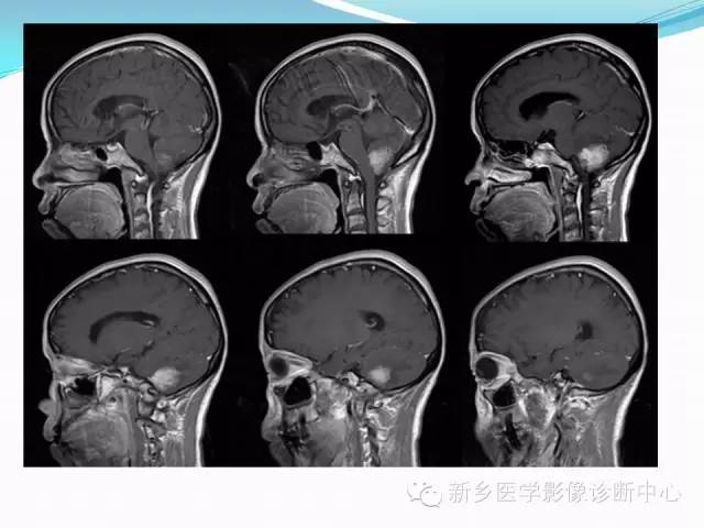 【病例】成人小脑髓母细胞瘤1例影像表现