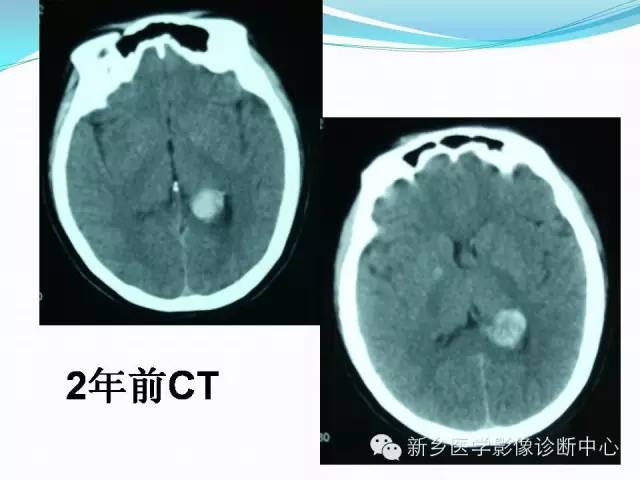 【病例】脑室海绵状血管瘤1例MR影像表现