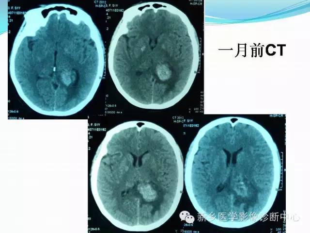 【病例】脑室海绵状血管瘤1例MR影像表现