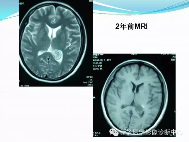 【病例】脑室海绵状血管瘤1例MR影像表现