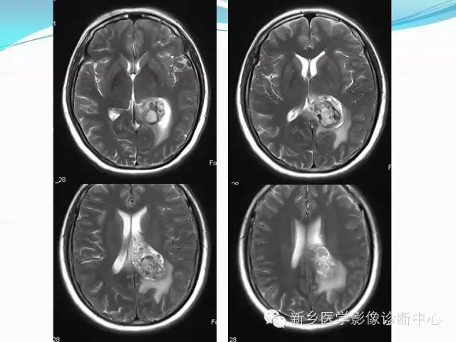 【病例】脑室海绵状血管瘤1例MR影像表现