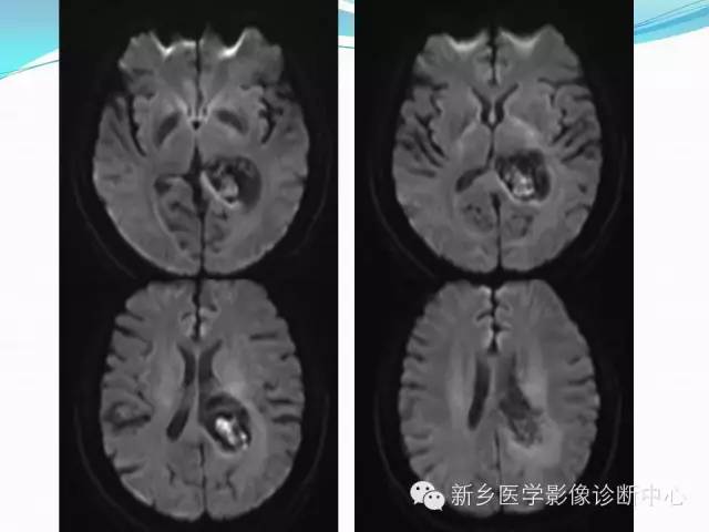 【病例】脑室海绵状血管瘤1例MR影像表现