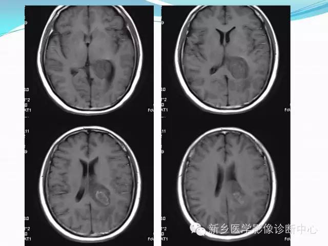 【病例】脑室海绵状血管瘤1例MR影像表现