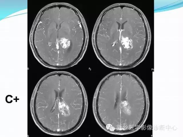 【病例】脑室海绵状血管瘤1例MR影像表现