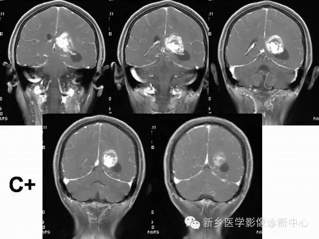 【病例】脑室海绵状血管瘤1例MR影像表现