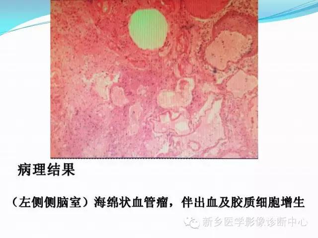 【病例】脑室海绵状血管瘤1例MR影像表现