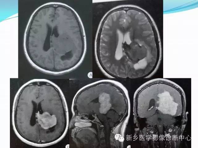 【病例】脑室海绵状血管瘤1例MR影像表现