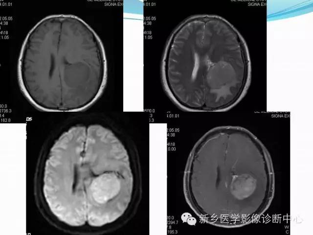 【病例】脑室海绵状血管瘤1例MR影像表现