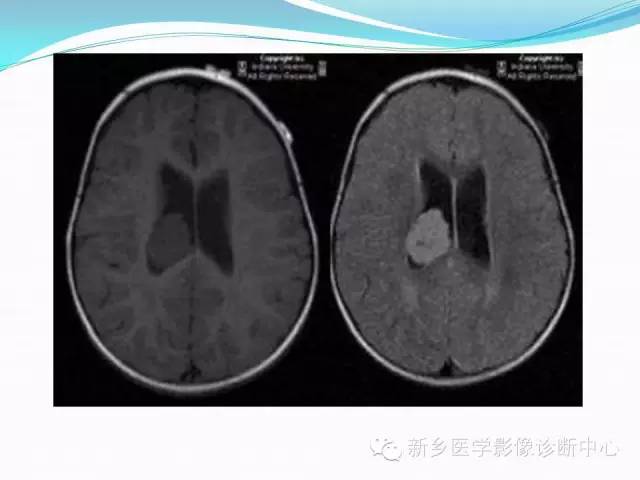 【病例】脑室海绵状血管瘤1例MR影像表现