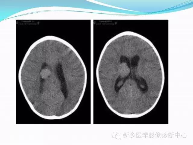 【病例】脑室海绵状血管瘤1例MR影像表现