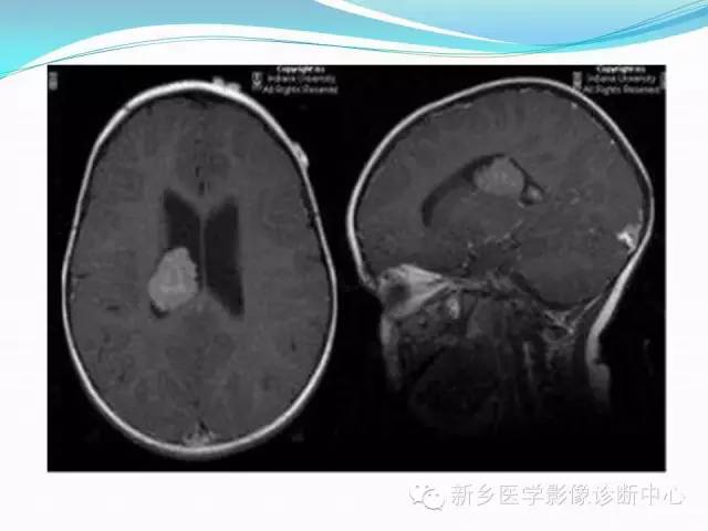 【病例】脑室海绵状血管瘤1例MR影像表现