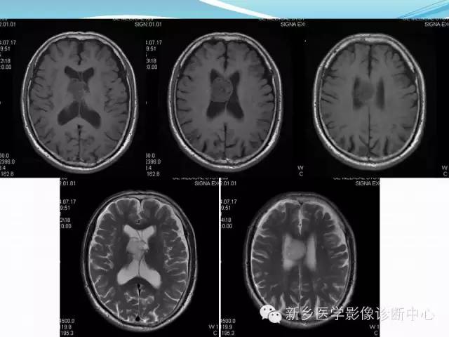 【病例】脑室海绵状血管瘤1例MR影像表现