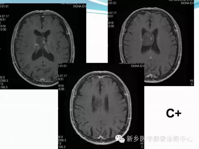 【病例】脑室海绵状血管瘤1例MR影像表现