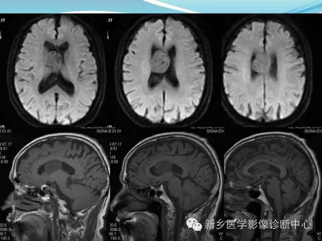 【病例】脑室海绵状血管瘤1例MR影像表现