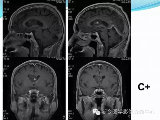 【病例】脑室海绵状血管瘤1例MR影像表现