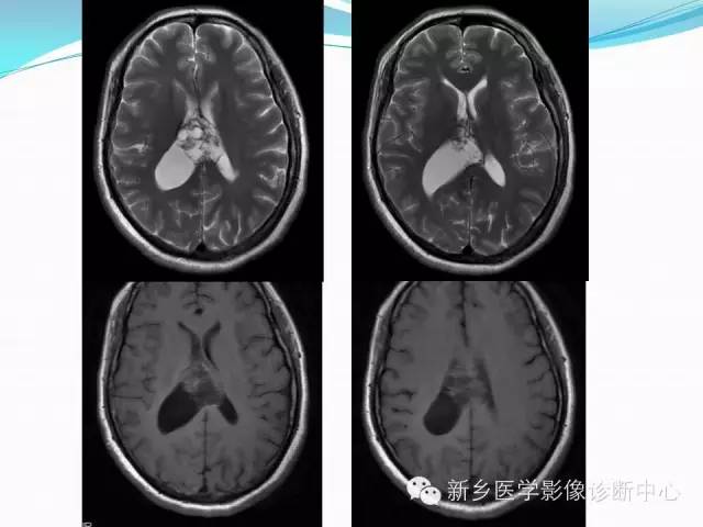【病例】脑室海绵状血管瘤1例MR影像表现
