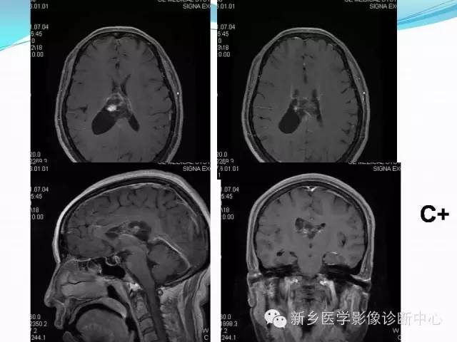 【病例】脑室海绵状血管瘤1例MR影像表现