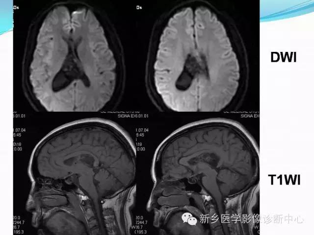 【病例】脑室海绵状血管瘤1例MR影像表现