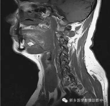 颈部失状位解剖+详细标注