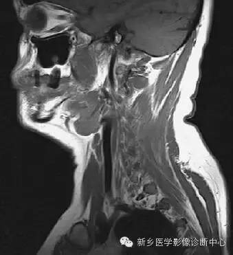 颈部失状位解剖+详细标注