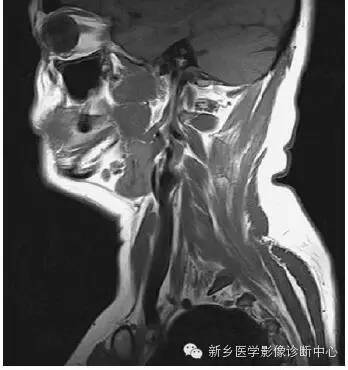 颈部失状位解剖+详细标注