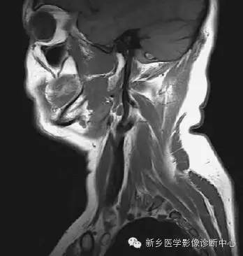 颈部失状位解剖+详细标注