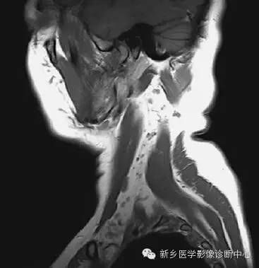 颈部失状位解剖+详细标注