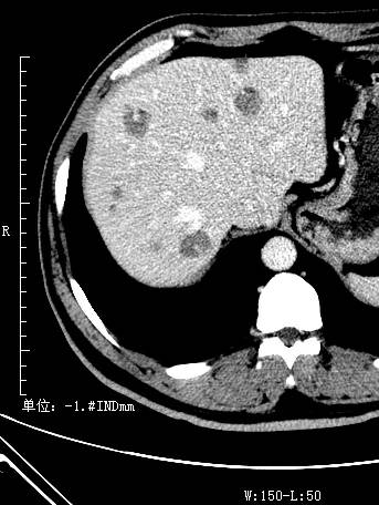 【病例】不典型肝血管瘤1例CT影像表现 【病例】不典型肝血管瘤1例CT影像表现