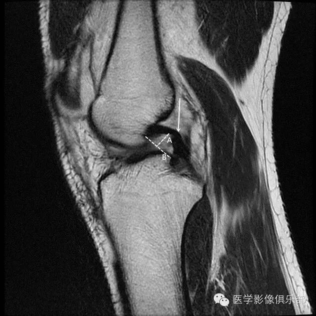 膝关节之前交叉韧带断裂的二级表现 膝关节之前交叉韧带断裂的二级表现