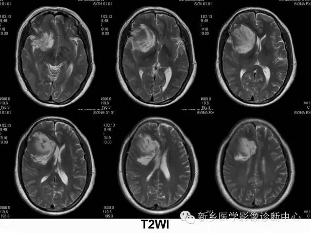 【病例】右额叶表皮样囊肿1例MR影像表现与鉴别