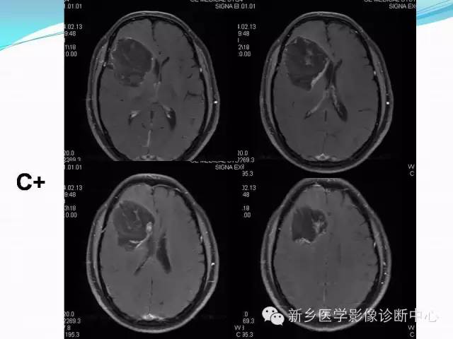 【病例】右额叶表皮样囊肿1例MR影像表现与鉴别