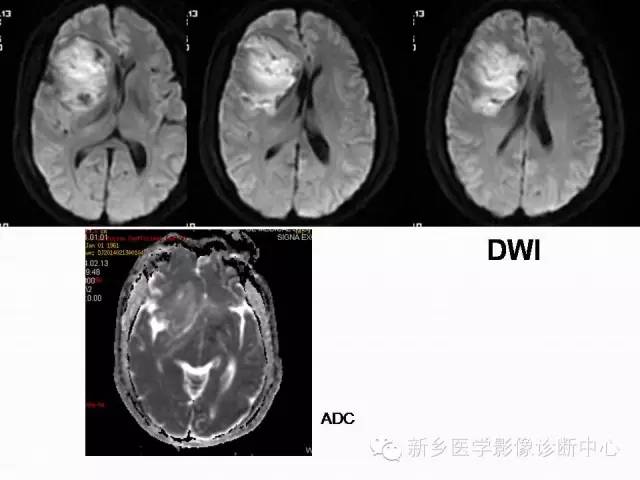 【病例】右额叶表皮样囊肿1例MR影像表现与鉴别