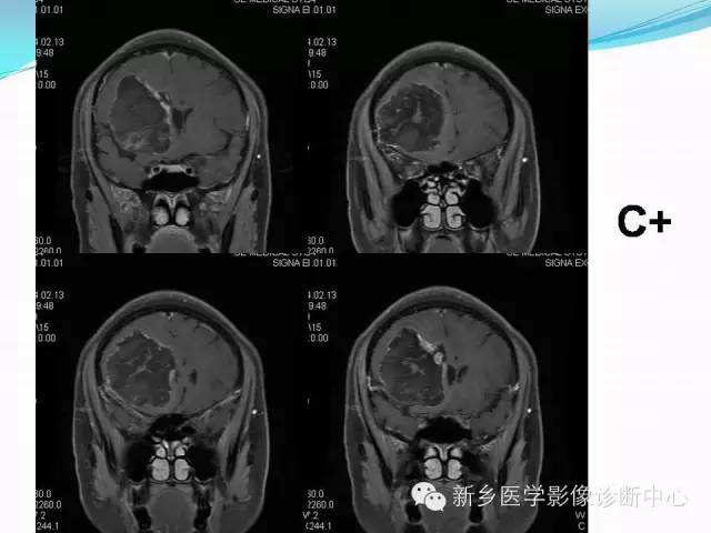 【病例】右额叶表皮样囊肿1例MR影像表现与鉴别