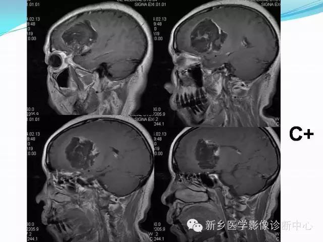 【病例】右额叶表皮样囊肿1例MR影像表现与鉴别