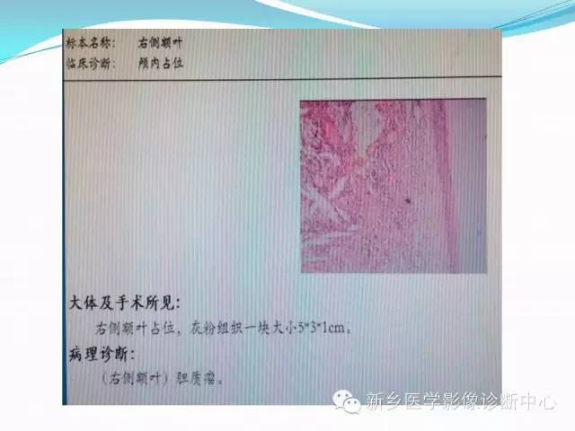 【病例】右额叶表皮样囊肿1例MR影像表现与鉴别