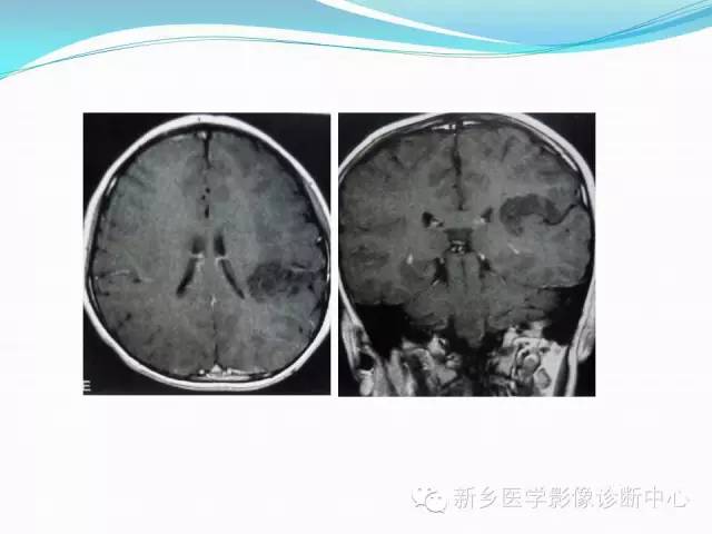 【病例】右额叶表皮样囊肿1例MR影像表现与鉴别