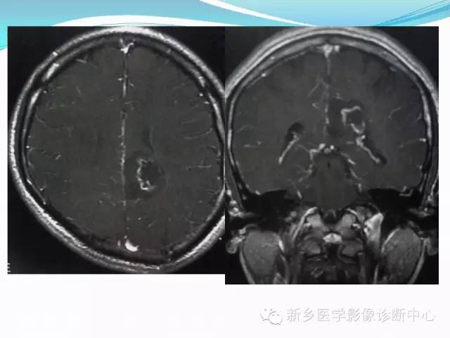 【病例】右额叶表皮样囊肿1例MR影像表现与鉴别