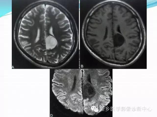 【病例】右额叶表皮样囊肿1例MR影像表现与鉴别