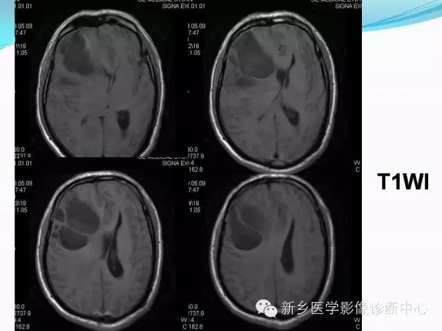 【病例】右额叶表皮样囊肿1例MR影像表现与鉴别