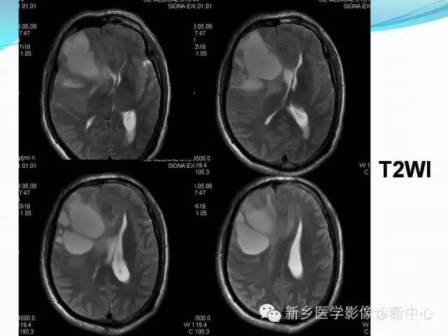 【病例】右额叶表皮样囊肿1例MR影像表现与鉴别
