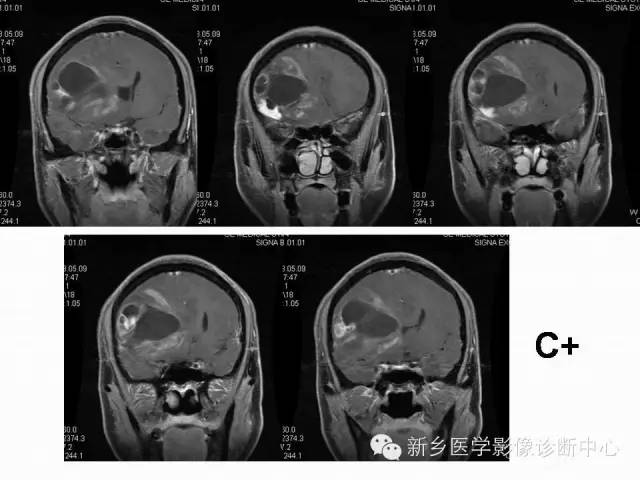 【病例】右额叶表皮样囊肿1例MR影像表现与鉴别
