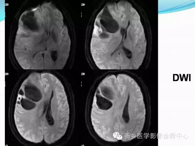 【病例】右额叶表皮样囊肿1例MR影像表现与鉴别